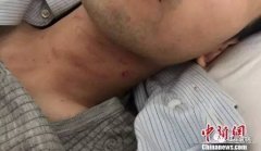 被打中国游客的含血呼吁:宁可不去越南,也不在中国护照里夹钱了