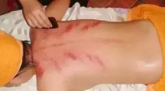 以下人群是不适合去刮痧、拔罐、推拿的,您适合吗?